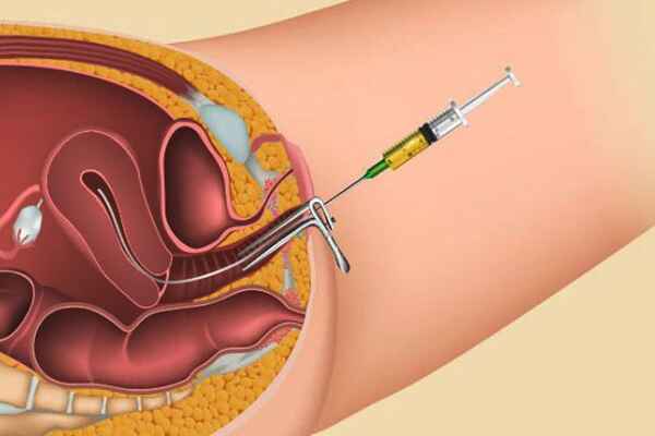 Exploring the Purpose of Intrauterine Insemination (IUI) in Fertility Treatment