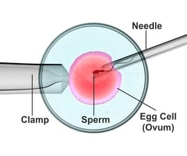ICSI - Intracytoplasmic sperm injection Treatment in Bangalore