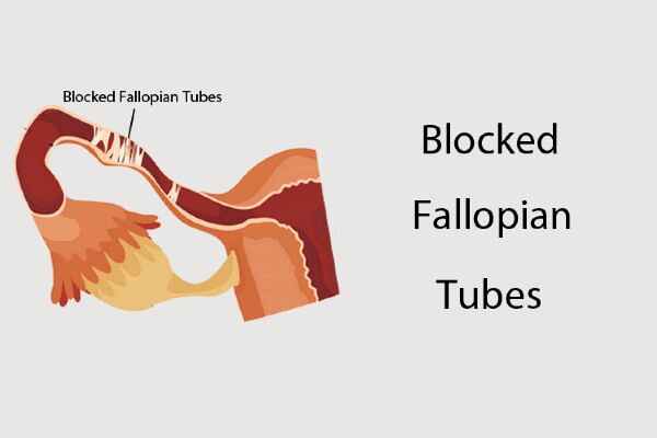 Understanding Blocked or Damaged Fallopian Tubes: Causes, Symptoms, and Treatment Options